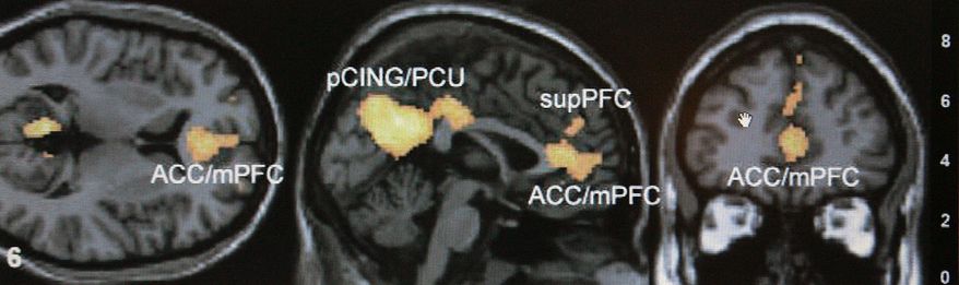 FILE - This Jan. 30, 2006 file photo shows a functional magnetic resonance imaging scan on a computer screen at an Emory University lab in Atlanta. Using large magnets, the scans detect where oxygenated blood flows, allowing scientists to indirectly measure brain activity. Researchers are becoming increasingly critical of some brain scan studies that purport to show exactly how our minds shape our behavior. (AP Photo/Ric Feld, File)
