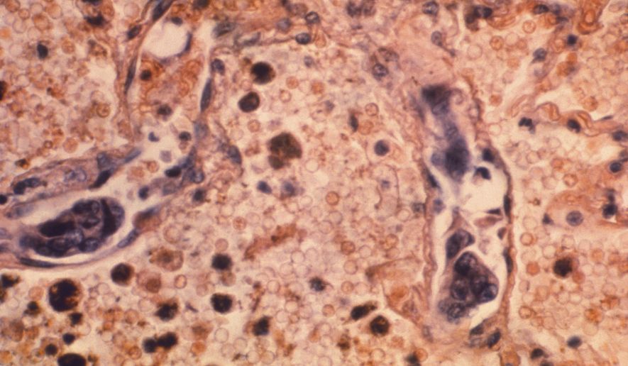 FILE - This 1964 photo made available by the Centers for Disease Control and Prevention shows a lung tissue specimen from a patient with adenocarcinoma of the lung. On Tuesday, Jan. 12, 2021, researchers reported another record one-year decline in the U.S. cancer death rate, a drop they continue to attribute to success against lung cancer. (Dr. Ellis/Emory University, Department of Pathology/CDC via AP)