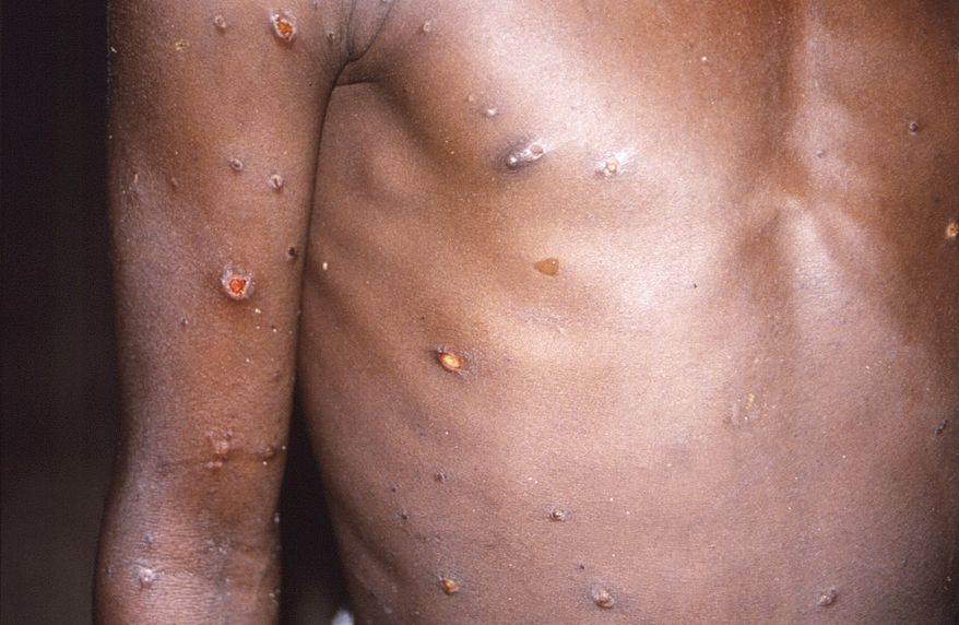 This 1997 image provided by CDC, shows the right arm and torso of a patient, whose skin displayed a number of lesions due to what had been an active case of monkeypox.  As more cases of monkeypox are detected in Europe and North America in 2022, some scientists who have monitored numerous outbreaks in Africa say they are baffled by the unusual disease&#39;s spread in developed countries.  (CDC via AP)