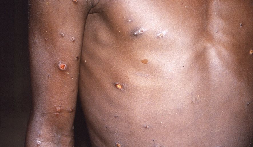This 1997 image provided by U.S. Centers for Disease Control and Prevention shows the right arm and torso of a patient, whose skin displayed a number of lesions due to what had been an active case of monkeypox. As health authorities in Europe and elsewhere roll out vaccines and drugs to stamp out the biggest monkeypox outbreak beyond Africa, in 2022, some doctors are acknowledging an ugly reality: The resources to slow the disease&#39;s spread have long been available, just not to the Africans who have dealt with it for decades. (CDC via AP, File)