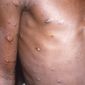 This 1997 image provided by U.S. Centers for Disease Control and Prevention shows the right arm and torso of a patient, whose skin displayed a number of lesions due to what had been an active case of monkeypox. As health authorities in Europe and elsewhere roll out vaccines and drugs to stamp out the biggest monkeypox outbreak beyond Africa, in 2022, some doctors are acknowledging an ugly reality: The resources to slow the disease&#39;s spread have long been available, just not to the Africans who have dealt with it for decades. (CDC via AP, File)