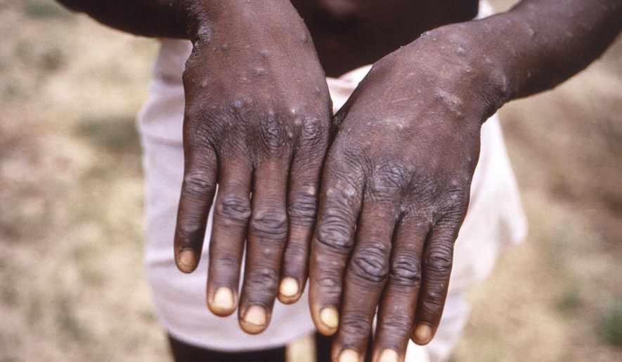 This 1997 image provided by the CDC during an investigation into an outbreak of monkeypox, which took place in the Democratic Republic of the Congo (DRC), formerly Zaire, and depicts the dorsal surfaces of the hands of a monkeypox case patient, who was displaying the appearance of the characteristic rash during its recuperative stage. The World Health Organization is convening its emergency committee on Thursday, July 21, 2022, to consider for the second time within weeks whether the expanding outbreak of monkeypox should be declared a global crisis.  (CDC via AP, File)