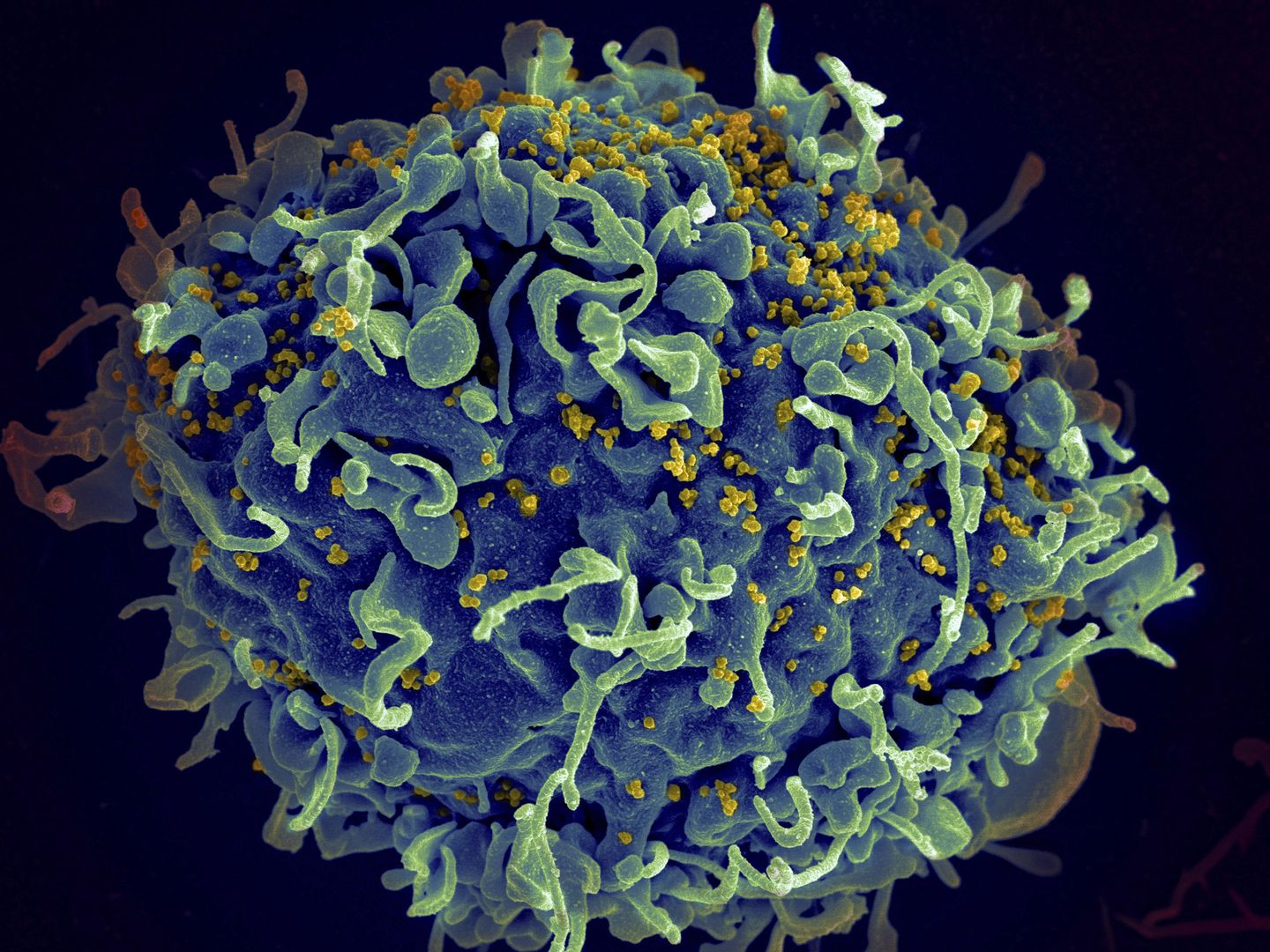 İki yeni HIV iyileşmesi vakası, bilim adamlarına geniş çapta kullanılabilir bir tedavi için umut veriyor