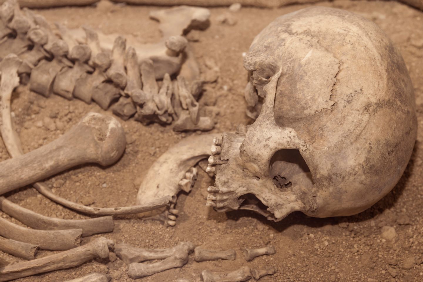 Endonezya'da bulunan 31.000 yıllık iskelet, bilinen en eski ampütasyon sergiliyor, yeni bir çalışma gösteriyor