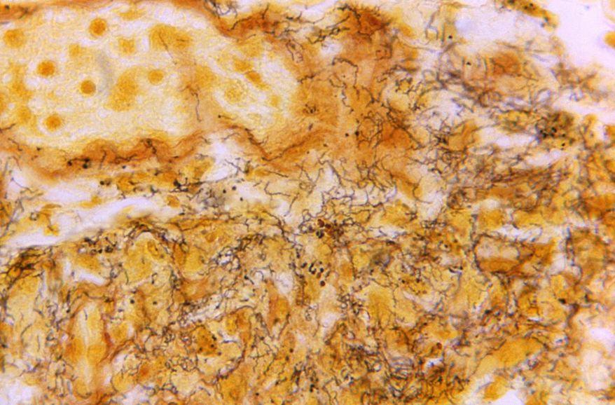 This 1966 microscope photo made available by the Centers for Disease Control and Prevention shows a tissue sample with the presence of numerous, corkscrew-shaped, darkly-stained, Treponema pallidum spirochetes, the bacterium responsible for causing syphilis. U.S. health officials on Monday, Sept. 19, 2022, are calling for a new push to prevent sexually transmitted diseases — spurred in part by a 26% increase in syphilis cases last year. (Skip Van Orden/CDC via AP)