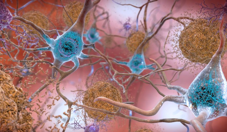 This illustration made available by the National Institute on Aging/National Institutes of Health depicts cells in an Alzheimer’s affected brain, with abnormal levels of the beta-amyloid protein clumping together to form plaques, brown, that collect between neurons and disrupt cell function. Abnormal collections of the tau protein accumulate and form tangles, blue, within neurons, harming synaptic communication between nerve cells. An experimental Alzheimer’s drug modestly slowed the brain disease’s inevitable worsening, researchers reported Tuesday, Nov. 29, 2022 — and the next question is how much difference that might make in people’s lives. Japanese drugmaker Eisai and its U.S. partner Biogen had announced earlier this fall that the drug lecanemab appeared to work, a badly needed bright spot after repeated disappointments in the quest for better Alzheimer’s treatments. (National Institute on Aging, NIH via AP)