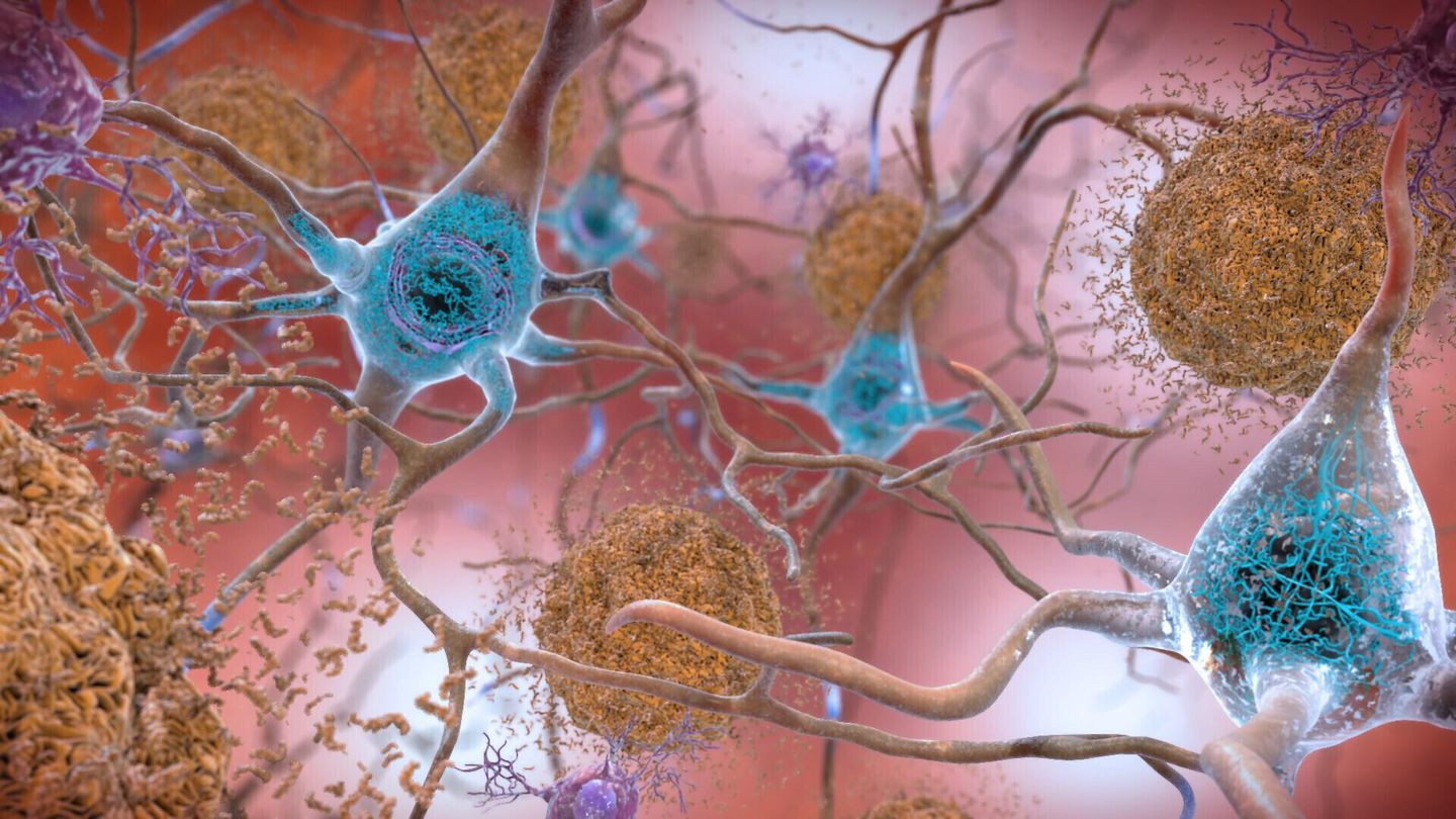Drug slows Alzheimer's, but can it make a real difference?