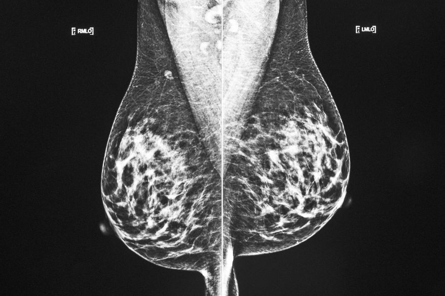 A technician displays images of a mammogram scan on a computer screen at a hospital in Odessa, Texas, on Wednesday, Oct. 20, 2021. A study discussed Friday, Dec. 9, 2022, at the San Antonio Breast Cancer Symposium finds many women with two or three breast tumors can get by with lumpectomy surgery instead of having their whole breast removed. (Eli Hartman|Odessa American via AP, File)