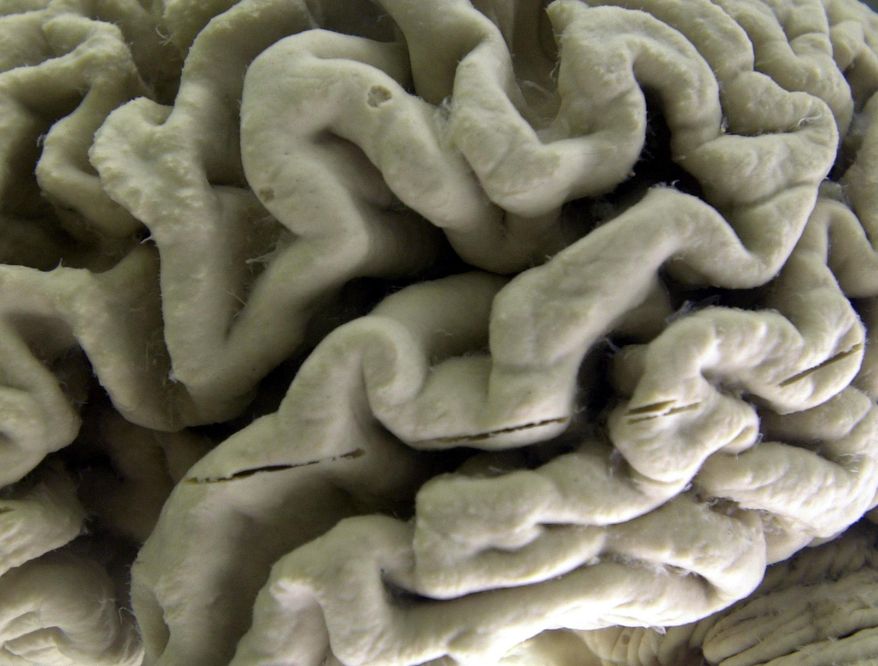 This Oct. 7, 2003, file photo shows a closeup of a human brain affected by Alzheimer's disease, on display at the Museum of Neuroanatomy at the University at Buffalo in Buffalo, N.Y. (AP Photo/David Duprey) ** FILE **