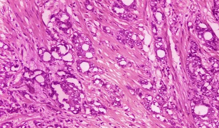 FILE - This 1974 microscope image made available by the Centers for Disease Control and Prevention shows changes in cells indicative of adenocarcinoma of the prostate. A study published by the New England Journal of Medicine on Saturday, March 11, 2023, finds long-term evidence that actively monitoring prostate cancer can be a safe alternative to immediate surgery or radiation. (Dr. Edwin P. Ewing, Jr./CDC via AP)