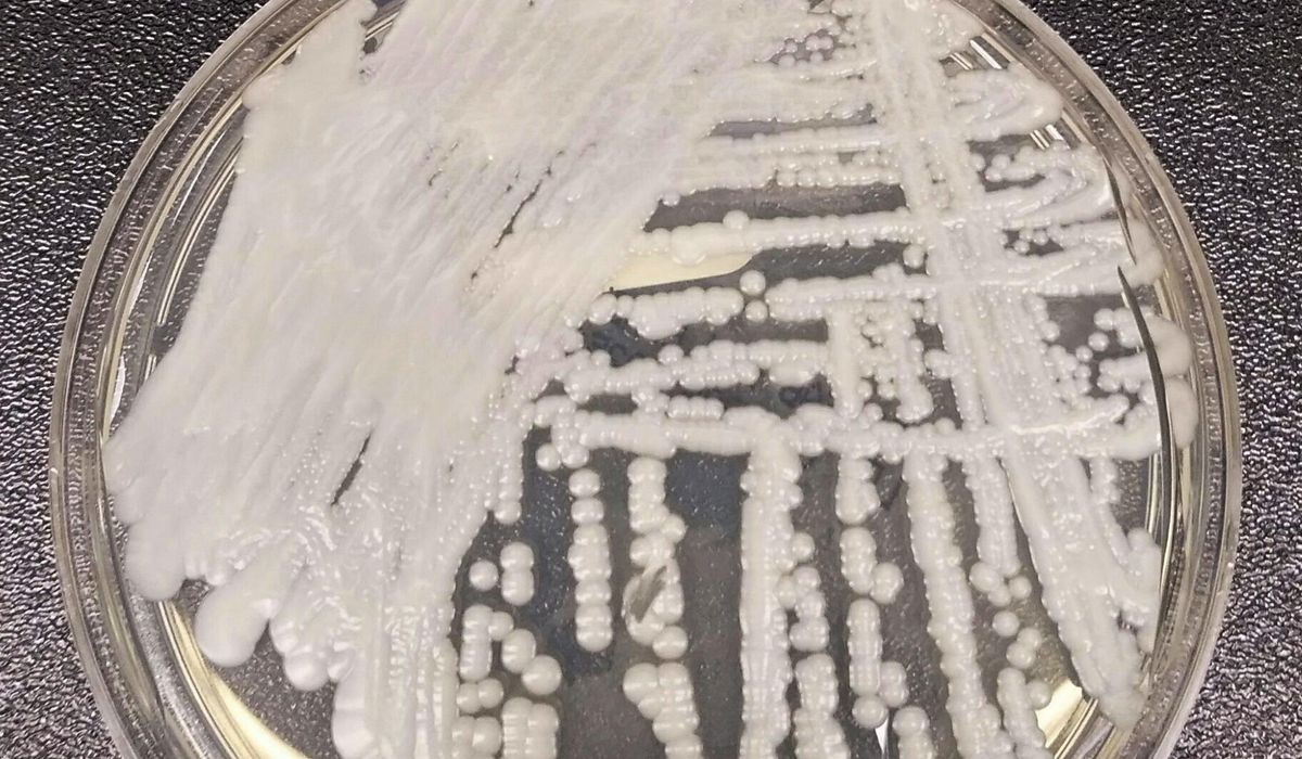 NextImg:Superbug fungus cases rose dramatically during pandemic