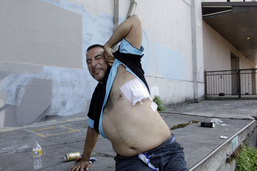 Jeremiah King, who is transitioning out of homelessness, grimaces in pain as he shows the bandage on a gunshot wound as he sits on the street after his hospital release in Portland, Ore., on July 27, 2022. A study released by the Centers for Disease Control and Prevention on Thursday, March 30, 2023, found U.S. gunshot injuries rose nearly 40% higher at the beginning of the pandemic, and in 2022 were still 20% higher than pre-pandemic levels. (AP Photo/Gillian Flaccus) **FILE**