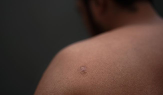 Asylum seeker Teodoso Vargas shows bullet wounds to his torso, after being shot nine times during a robbery in his native Honduras, Monday, May 22, 2023, as he waits to apply for asylum in the border city of Tijuana, Mexico. Asylum-seekers say joy over the end of the public health restriction known as Title 42 this month is turning into anguish with the realization of how the Biden administration&#x27;s new rules affect them. Though the government opened some new avenues for immigration, many people&#x27;s fate is largely left up to a U.S. government app that is limited and unable to decipher and prioritize human suffering and personal risk. (AP Photo/Gregory Bull)