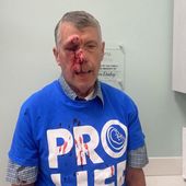 Mark Crosby, 73, of Baltimore County Right to Life suffered severe facial injuries in an attack while doing sidewalk counseling outside Planned Parenthood Baltimore City Health Center. Photo courtesy American Center for Law and Justice.