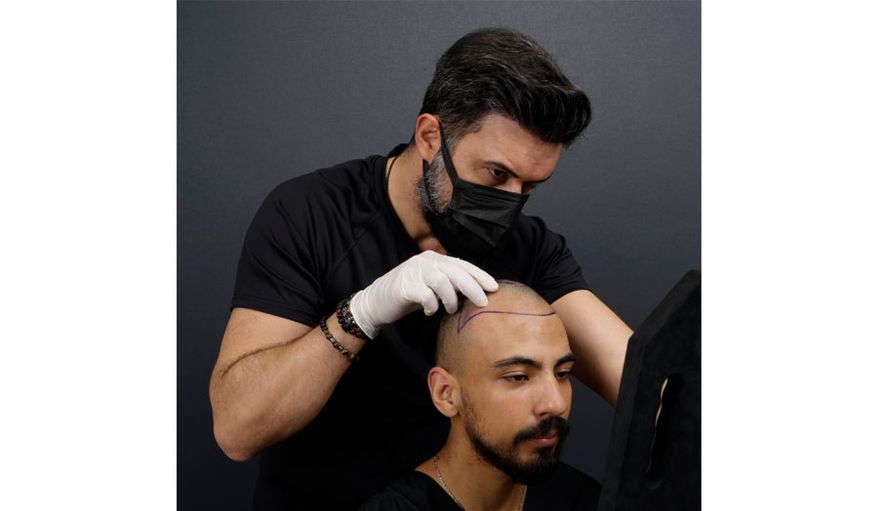 Why has hair transplant in Turkey become so popular? (sponsored)