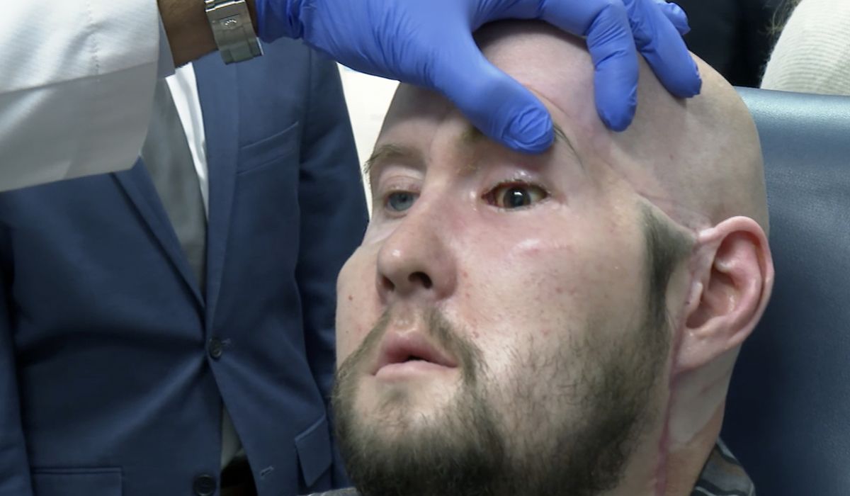 NextImg:New York University surgeons perform world’s first whole eye and partial face transplant