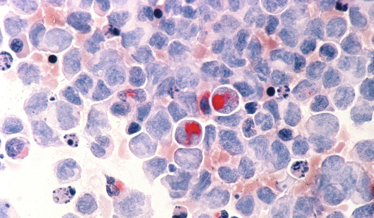 NextImg:Progress in childhood cancer has stalled for Blacks and Hispanics, report says