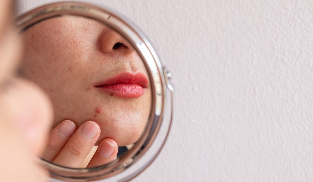 NextImg:Acne hurts social life, job prospects, study finds