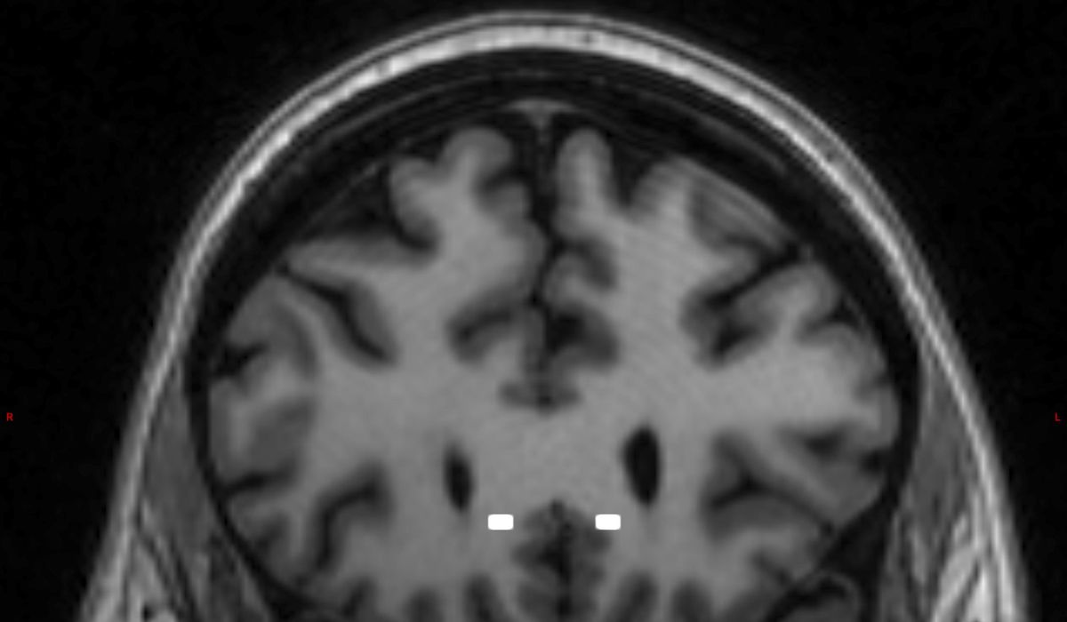 NextImg:Neuralink seeks more human test subjects for brain implant