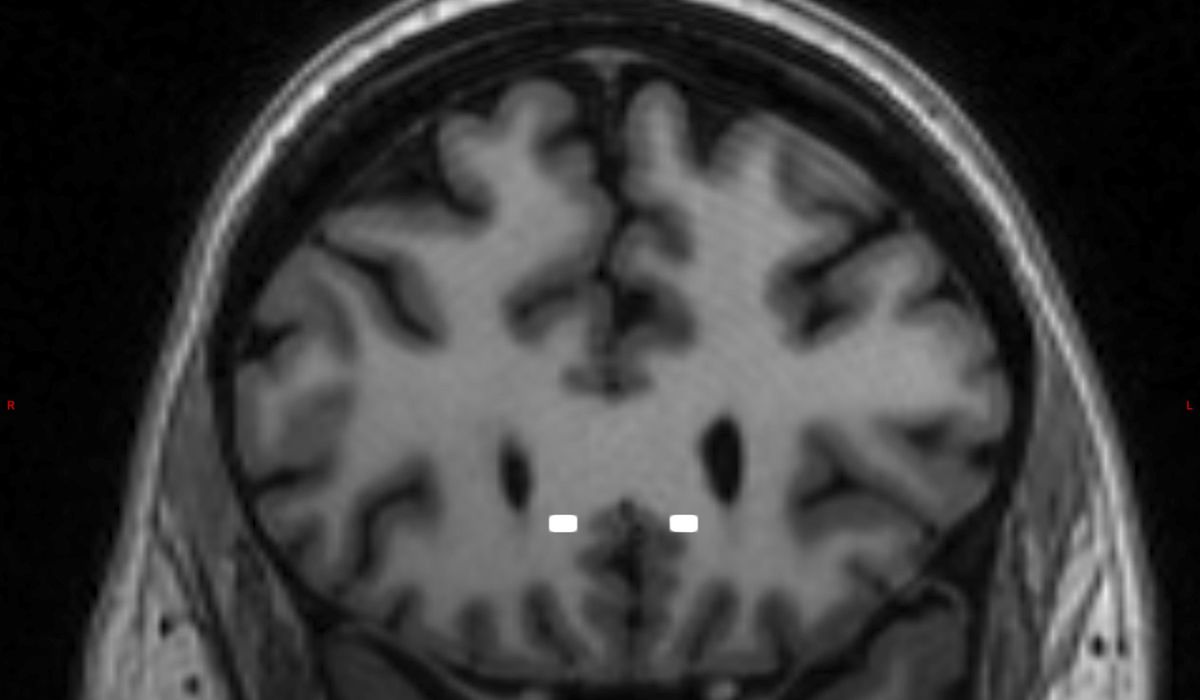NextImg:Neuralink’s first human brain implant malfunctions