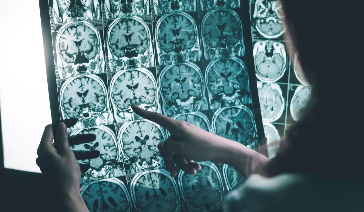 NextImg:Neuralink says second brain implant patient doing well