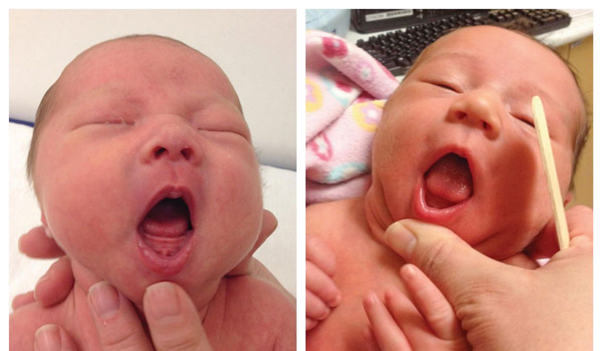 NextImg:Infants’ tongue-tie may be overdiagnosed and needlessly treated, American Academy of Pediatrics says