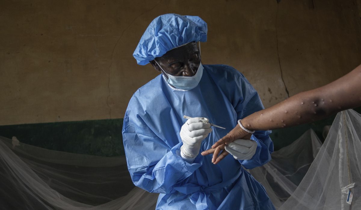 NextImg:New mpox strain in Congo raises concerns of increased spread