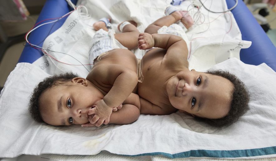 This photo provided by the Children’s Hospital of Philadelphia shows conjoined twins, Amari and Javar Ruffin, at the Children’s Hospital of Philadelphia, March 20, 2024. (Ed Cunicelli/Children’s Hospital of Philadelphia via AP)