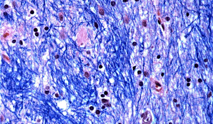This microscope photo provided by the McLean Hospital's Harvard Brain Tissue Resource Center in January 2024 shows cells in the caudate nucleus structure of the brain in a person with Huntington's disease. (McLean Hospital's Harvard Brain Tissue Resource Center/NIH NeuroBioBank via AP)