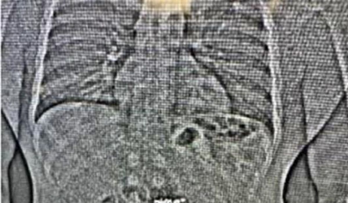 NextImg:X-ray shows diamond earrings swallowed by theft suspect during arrest, police say