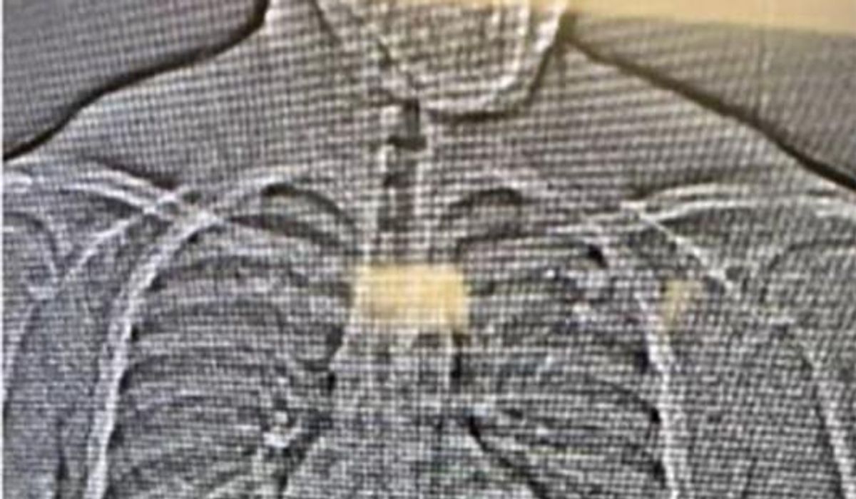 NextImg:$770,000 Tiffany jewelry swallowed by suspected thief, recovered