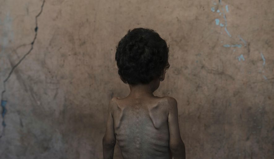 FILE.- Yazan Abu Ful, a 2-year-old malnourished child, poses for a photo at his family home in the Shati refugee camp, in Gaza City on Wednesday, July 23, 2025. (AP Photo/Jehad Alshrafi,File)