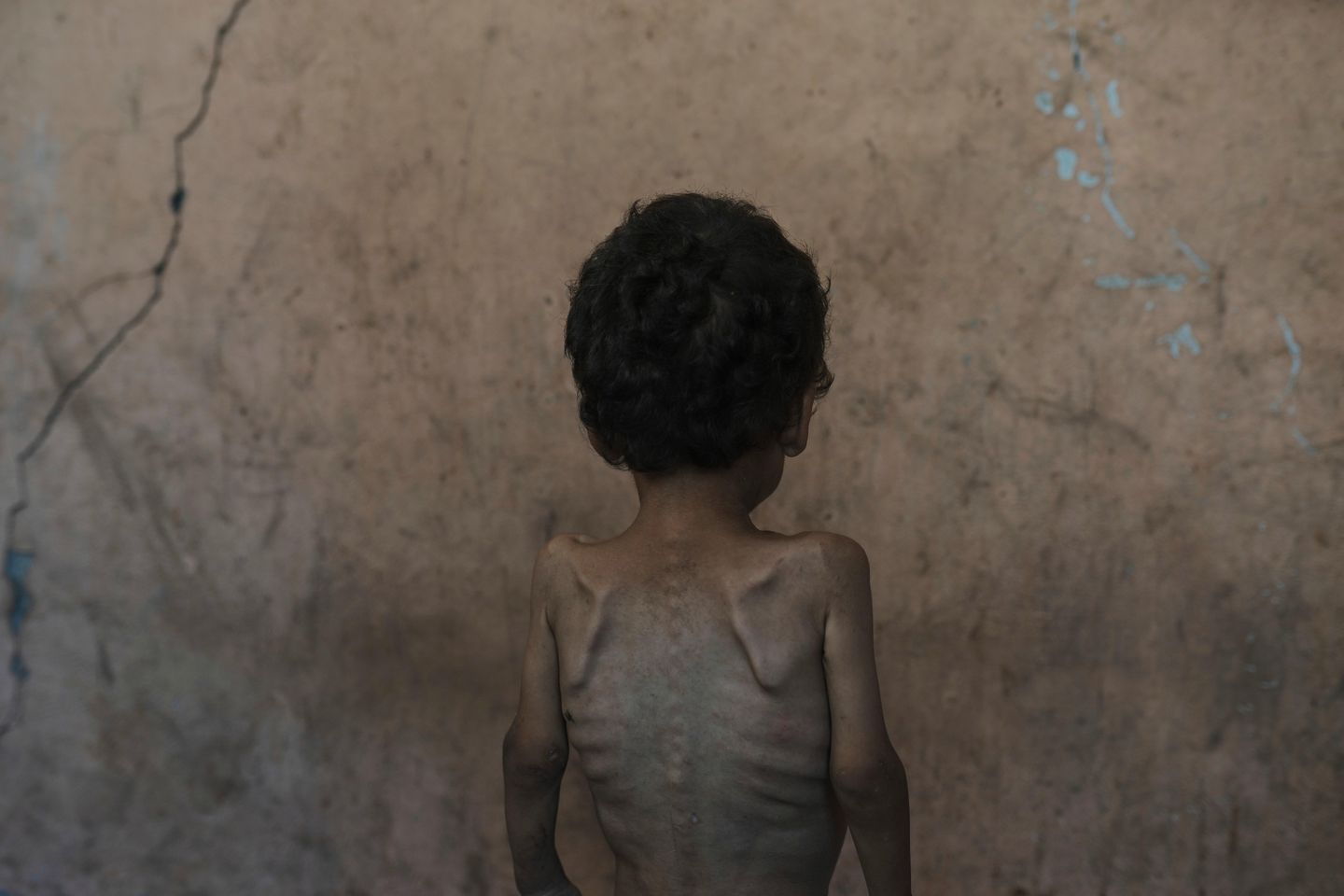 Nearly 55,000 children in Gaza under age 5 may be acutely malnourished, a new U.N. study finds