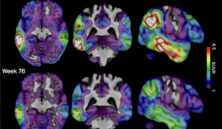 These brain scan images provided by Biogen show how high levels of Alzheimer's-related tau protein, in red, dropped in a recipient of the company's experimental drug diranersen. (Biogen via AP)