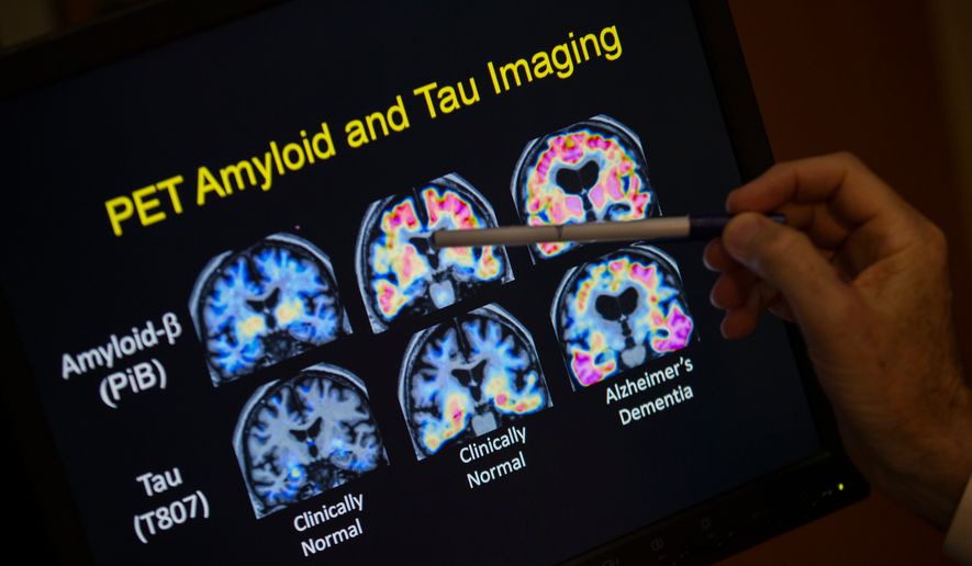 A doctor points to PET scan results that are part of a study on Alzheimer's disease at Georgetown University Hospital, on Tuesday, May 19, 2015, in Washington. (AP Photo/Evan Vucci, File)