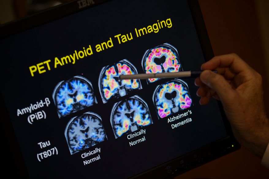 A doctor points to PET scan results that are part of a study on Alzheimer's disease at Georgetown University Hospital, on Tuesday, May 19, 2015, in Washington. (AP Photo/Evan Vucci, File)
